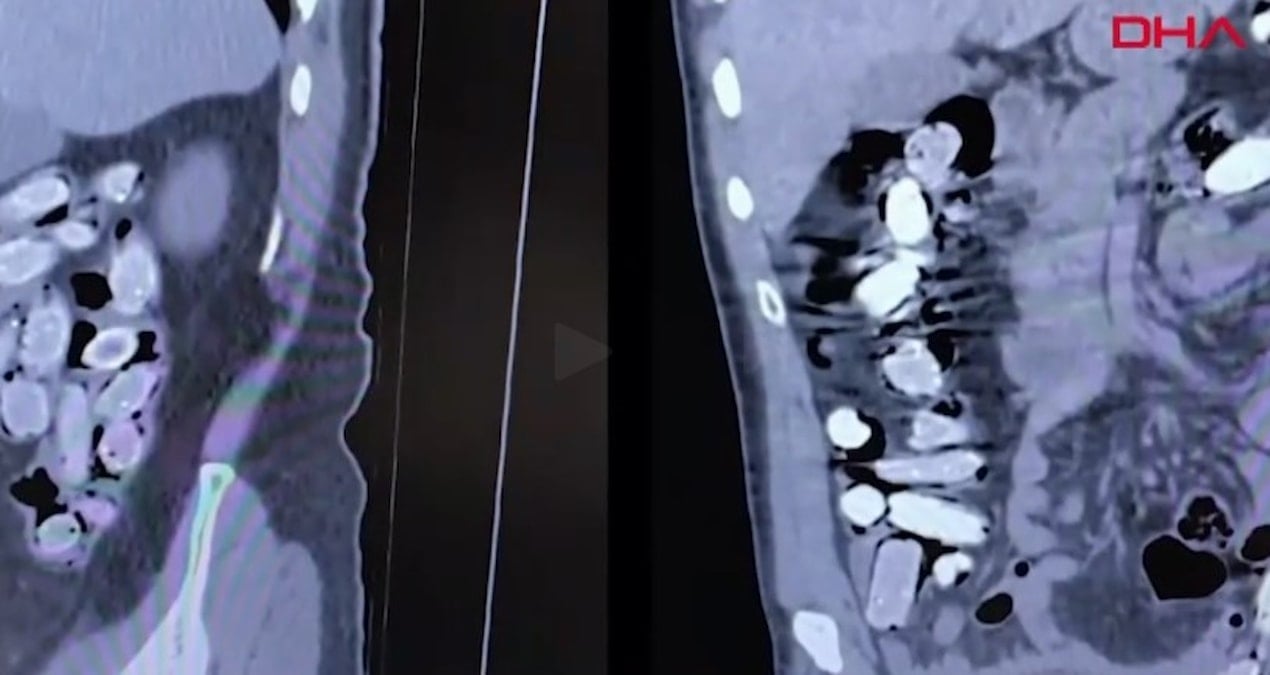 Bitlis’te 2 yabancının midesinden çıkanlar doktor ve polisleri şoke etti